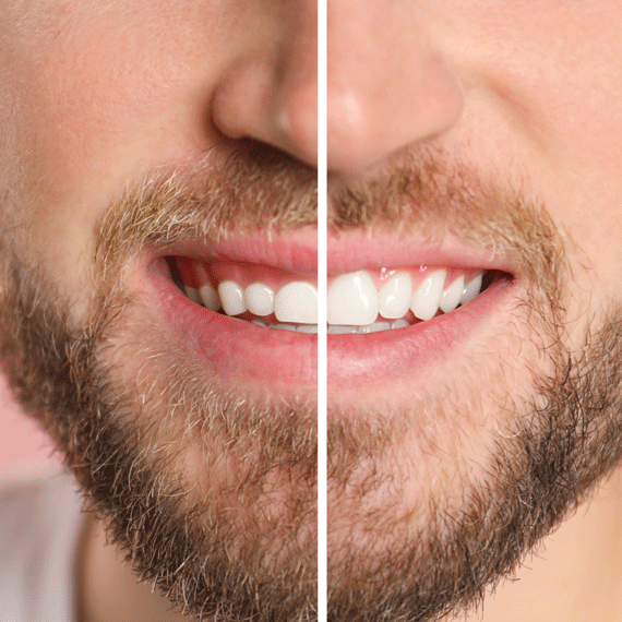 A before and after of gum contouring.