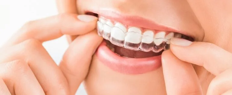 Invisalign Cost in Kitchener