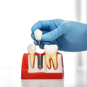 dental implants in Kitchener