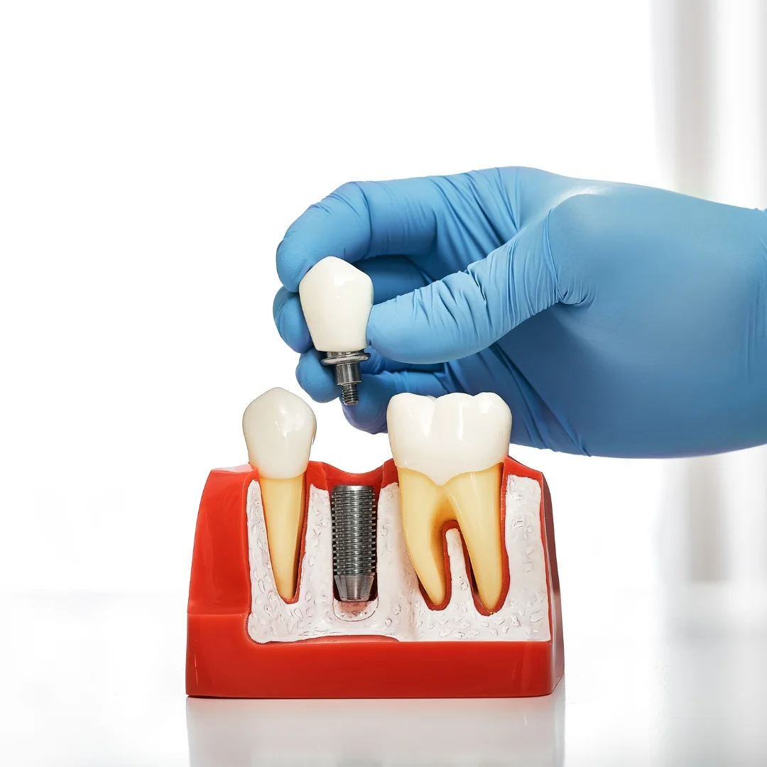 dental implants in Kitchener