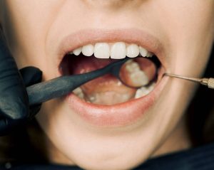 full mouth reconstruction in Kitchener