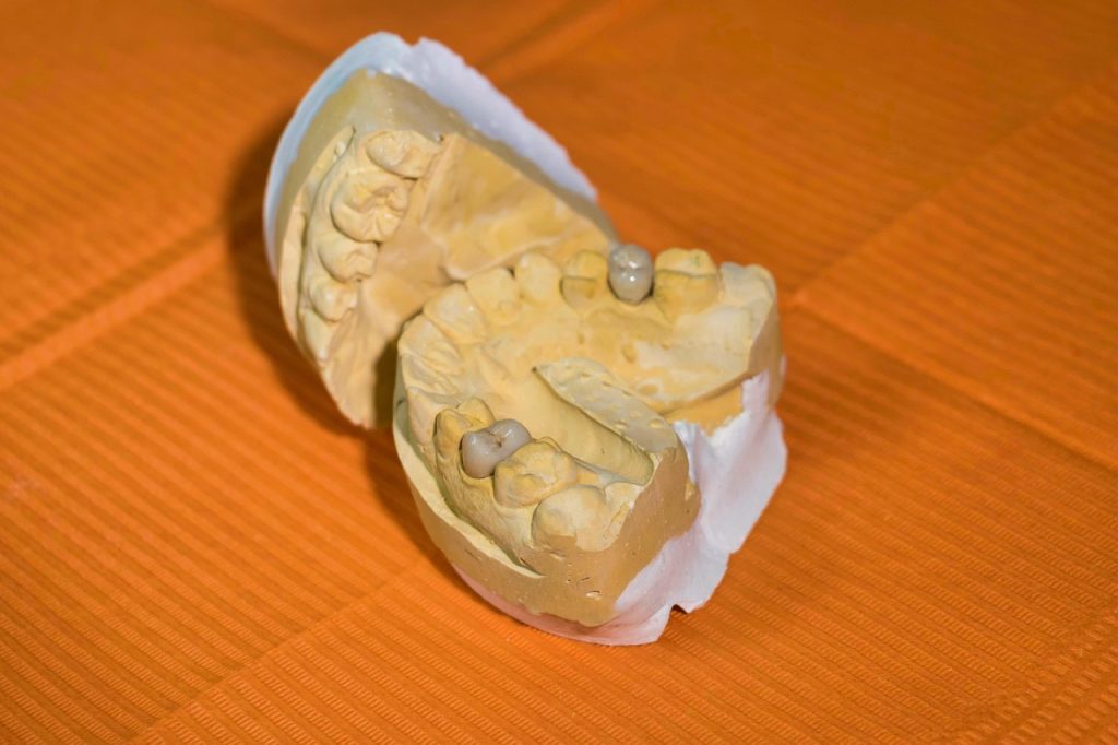 Dental lab model displaying crown restorations on prepared teeth against orange background