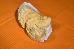 Dental lab model displaying crown restorations on prepared teeth against orange background