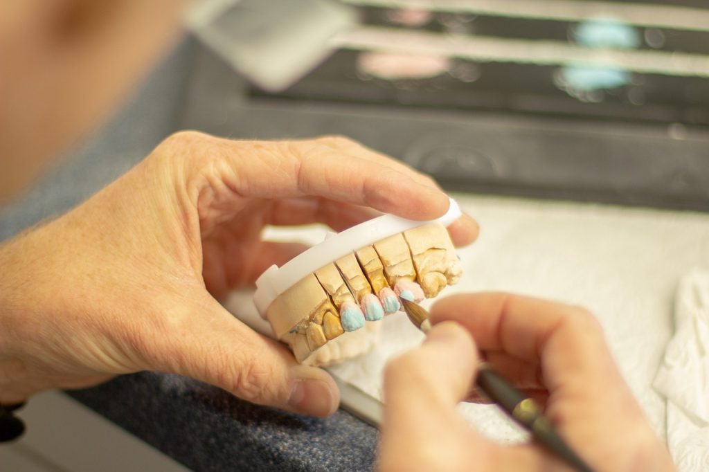 Dental technician applies color to a model showing inlay restorations on teeth