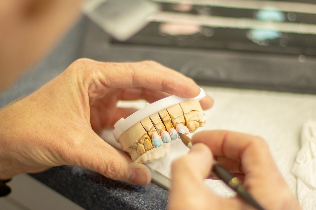 Dental technician applies color to a model showing inlay restorations on teeth