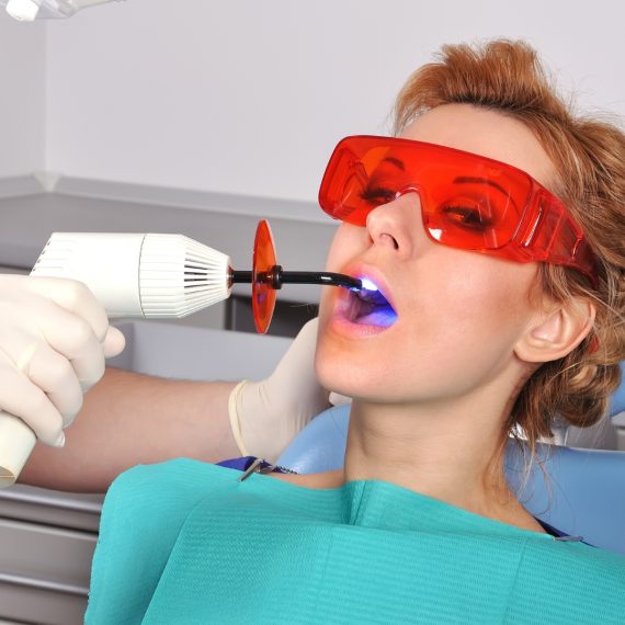 Dental Fillings