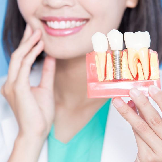 A woman holding a model of a dental implant.